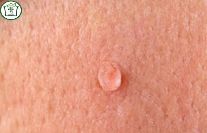 چگونه می_توان ویروس HPV و عوارض ناشی از آن را در خانه درمان کرد؟