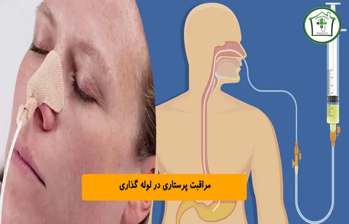 مراقبت پرستاری در لوله گذاری