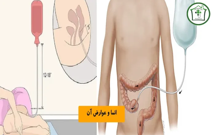 انما و عوارض آن