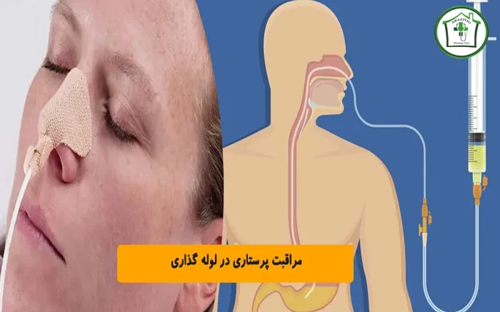 مراقبت پرستاری در لوله گذاری